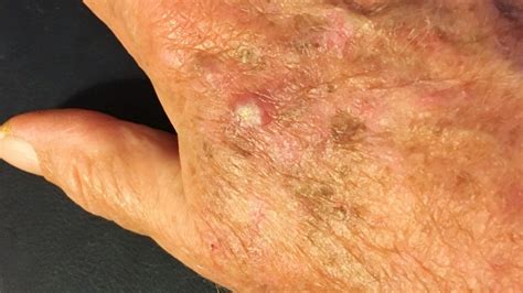 Actinic Keratosis Causes Symptoms And Treatment Options