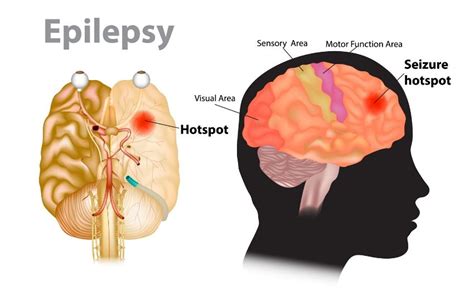 Epilepsy Awareness Patients Turn To Brain Surgery For Treatment Of