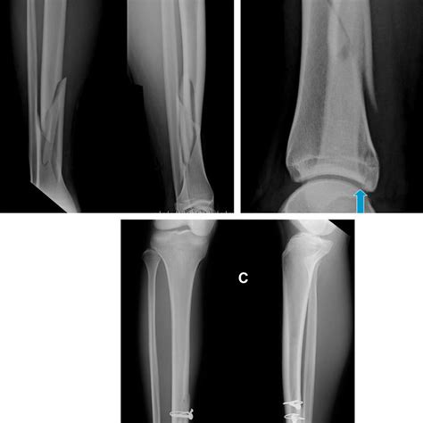 Information For Patients With Concomitant Tibia Shaft Fracture And