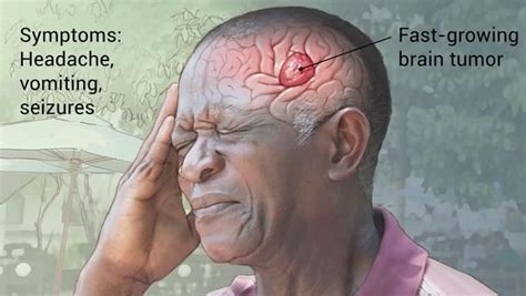 A Man With A Fast Growing Brain Tumour Experiencing A Severe Headache