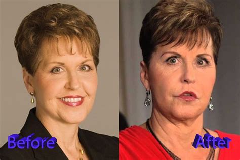 Joyce Meyer Plastic Surgery Before And After Plastic Surgery