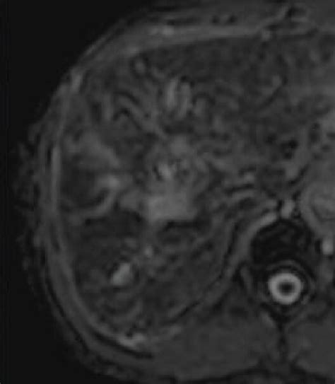 Mri Image Of Hepatocellular Carcinoma A T2wi B T1wi C Dwi D