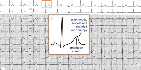 Normal T Waves Cardiocases