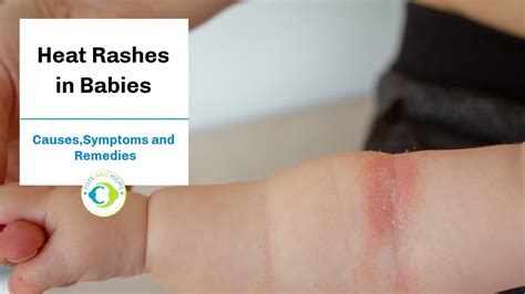 Heat Rashes In Babies Causes Treatments And Remedies