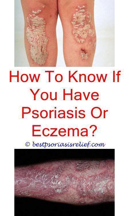 Mildpsoriasis The Difference Between Eczema And Psoriasis Psoriasis