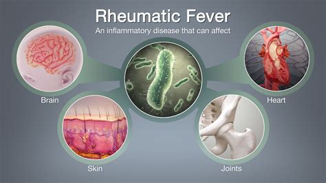 Rheumatic Fever Symptoms Causes And Treatment Scientific Animations