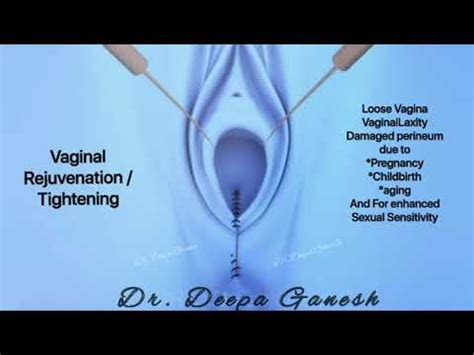 Vagina Tightening Animation Dr Deepa Ganesh Cosmetic Gynecologist Chennai YouTube