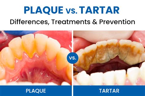 plaque vs tartar differences treatments and prevention