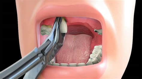 I am 52 years old my two front teeth are shifting still very pretty and white. Tooth Extraction Patient Education | MediaMed