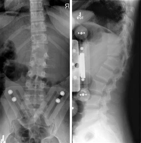 Flexion-distraction Fracture at T12-L1: Brace or Surgery
