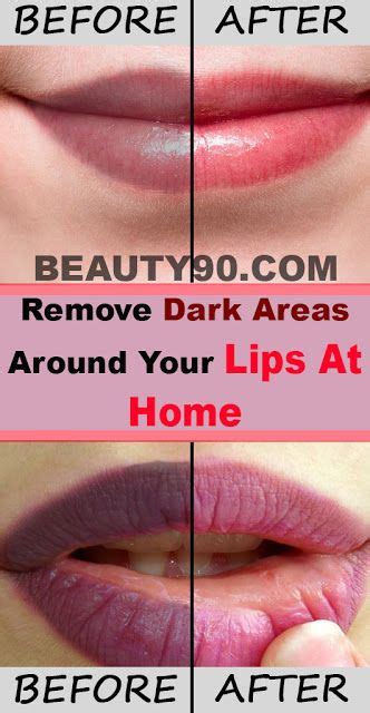 Remove Dark Areas Around Your Lips At Home Lips How To Remove Your Lips