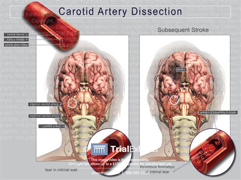 Carotid Artery Dissection Trial Exhibits Inc