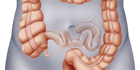Major part of large intestine, the final section of the digestive system. Polyps in the colon (large bowel)