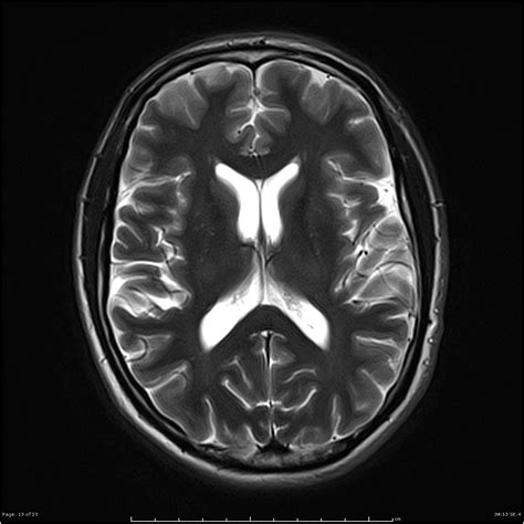 Cavum Septum Pellucidum Image