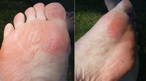 How Long Do Blisters Take To Heal Blister Prevention