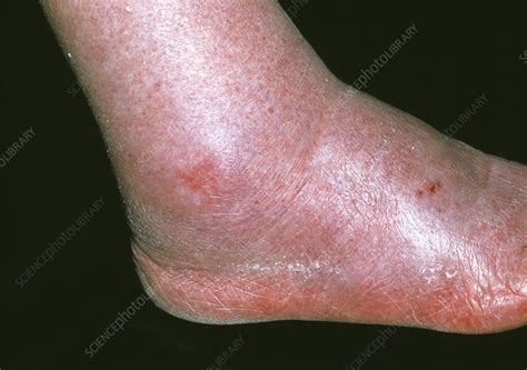 Swollen Ankle Due To Oedema Stock Image M2300258 Science Photo Library