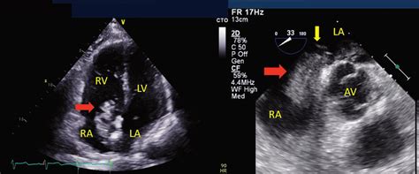 Patent Foramen Ovale Pfo With Thrombus In Transit Intraoperative