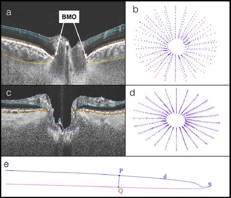 Compensated Spectral Domain Optical Coherence Tomography Sdoct