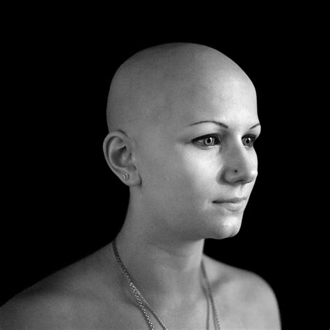 Classification of the types of androgenetic alopecia (common baldness) occurring in the female sex. Alopecia Universalis | hair transplant using beard hair it ...