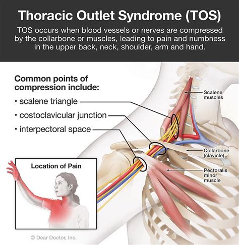 Thoracic Outlet Syndrome Pain Patterns Causes Self Care Vrogue