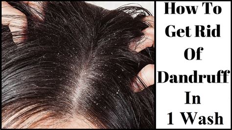 How To Remove Dandruff Just In 1 Wash Home Remedies For Dandruff