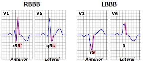 Bundle Branch Blocks Cardio Guide