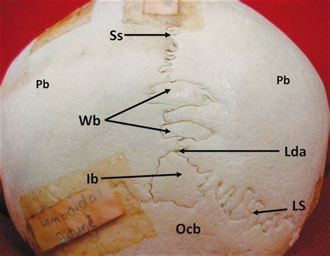 Superior View Of The Skull Cap Showing The Wormian Bones In The