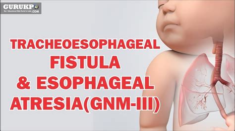 Tracheoesophageal Fistula Esophageal Atresia GNM III YouTube