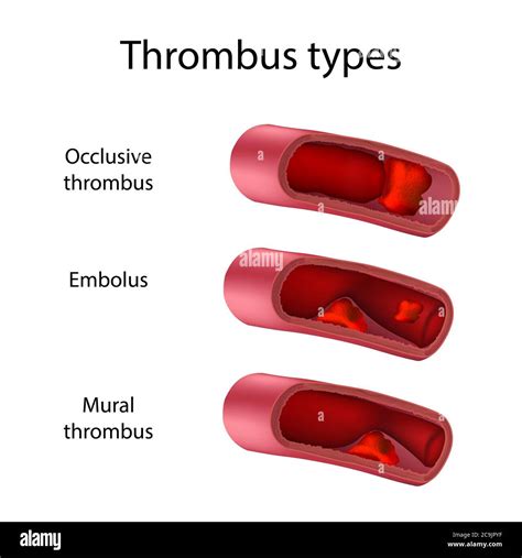 Thrombus Types Illustration Comparison Of Occlusive Embolus And