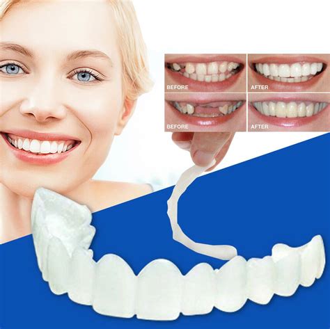 Aspen dental practices offer a variety of dental veneer options to choose from. Perfect teeth Clip on Veneers | Veneers teeth, Teeth clip, Perfect teeth