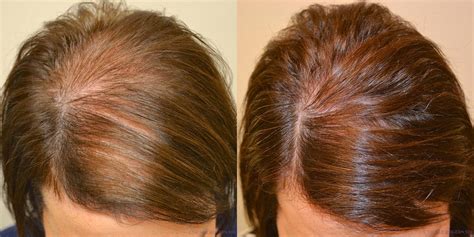 Spironolactone helps about 30 % of. Spironolactone - Hair Restoration of the South - New ...