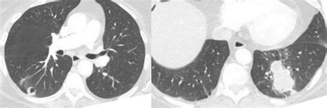 Actinomyces Meyeri Causing Disseminated Actinomycosis In The Presence Of Concurrent Bronchogenic