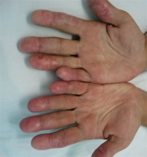 Sporotrichosis is a skin infection caused by the fungus sporothrix schenckii. Sporotrichosis: Diagnosis and Management | Consultant360