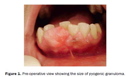 Pyogenic Granuloma A Case Report Open Access Journals