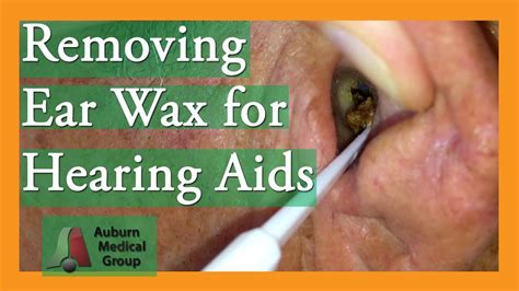 How to clean hearing aids of wax. Removing Ear Wax for Hearing Aids #earwaxremoval | Auburn ...