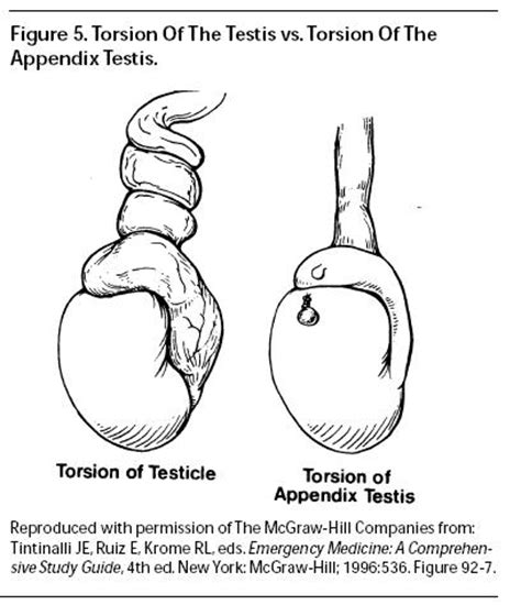 Testicular Appendage Torsion Ultrasound