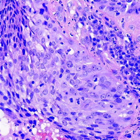 Squamous Cell Carcinoma Of The Cervix Nonkeratinizing Carcinoma