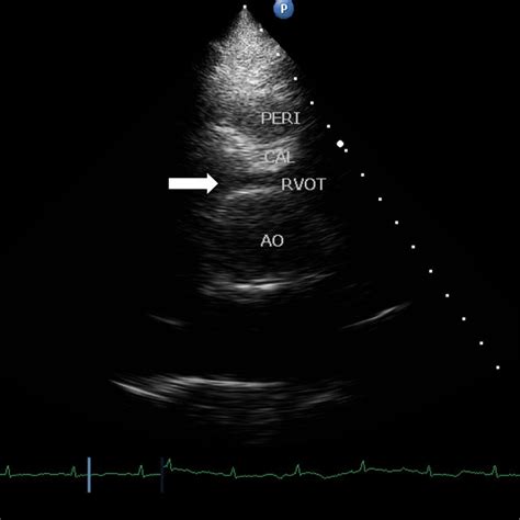 Pdf Chronic Constrictive Pericarditis With Right Ventricular Outflow