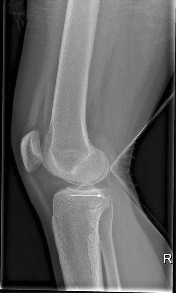 Tibial Plateau Fracture X Ray