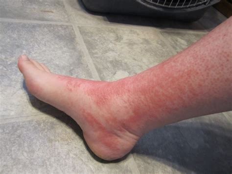 Bright Red Rash On Leg Above Ankle Foto Bugil Bokep 2017