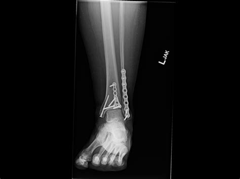 Ortho Dx Chronic Ankle Pain Following Surgery Clinical Advisor