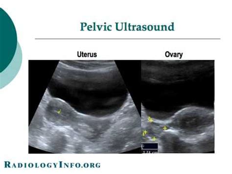 Your Radiologist Explains Pelvic Obstetric Ultrasound YouTube