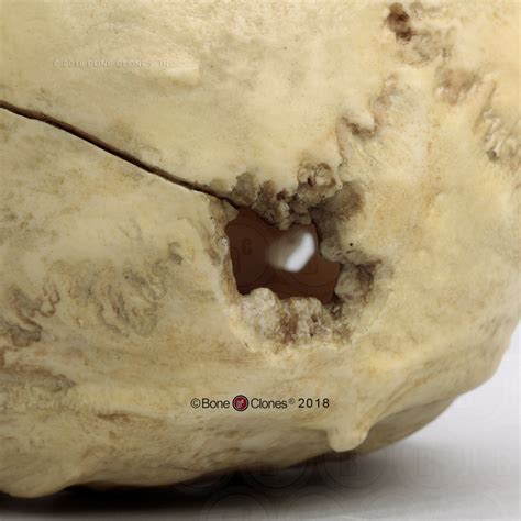 Unless it's a light beer, then. Human Male Skull with a 32-caliber Gunshot Wound - Bone Clones, Inc. - Osteological Reproductions