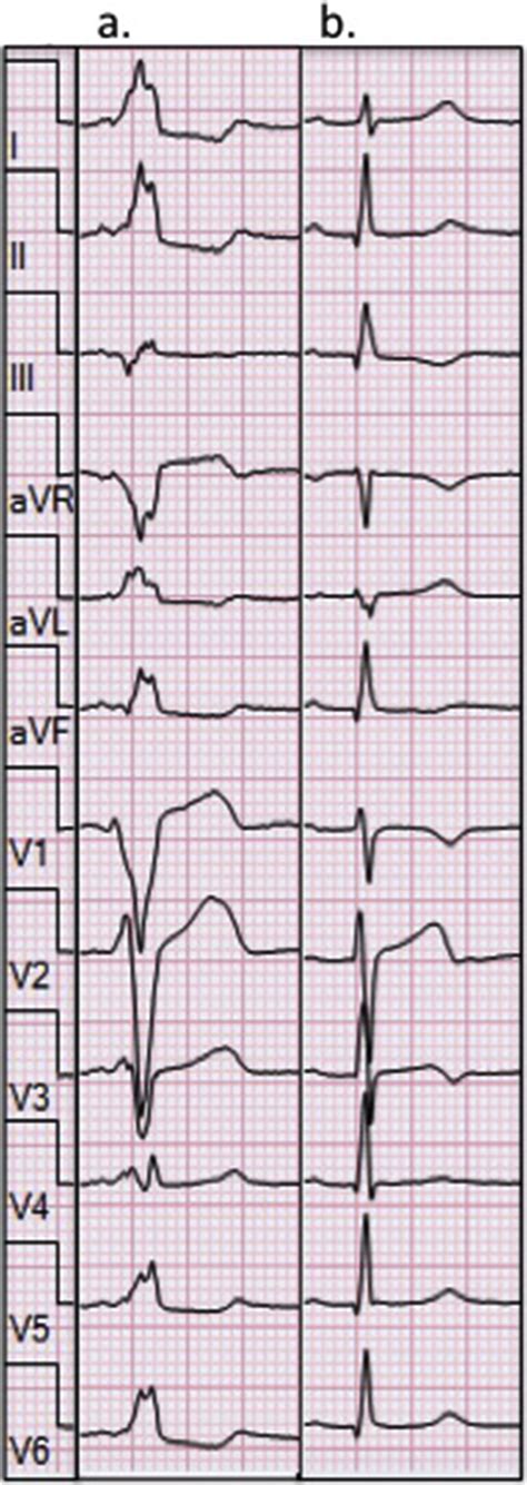 A Sinus Rhythm With Short Pr Interval And Fully Pre Excited Qrs With