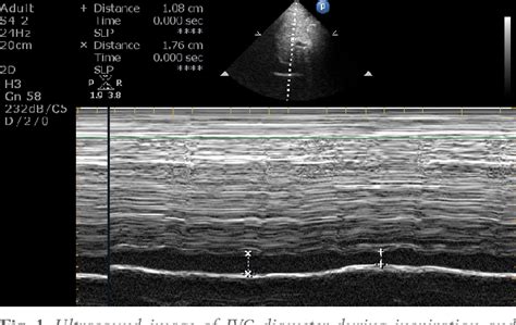 The Role Of Mitral Annular Plane Systolic Excursion In Prediction Of