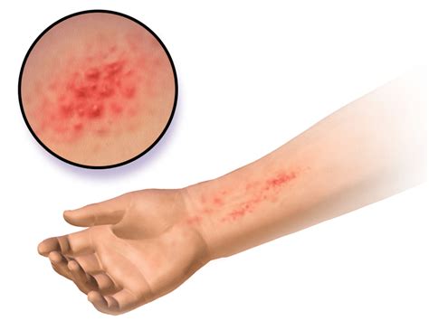 Difference Between Anaphylaxis And Allergic Reaction Compare The