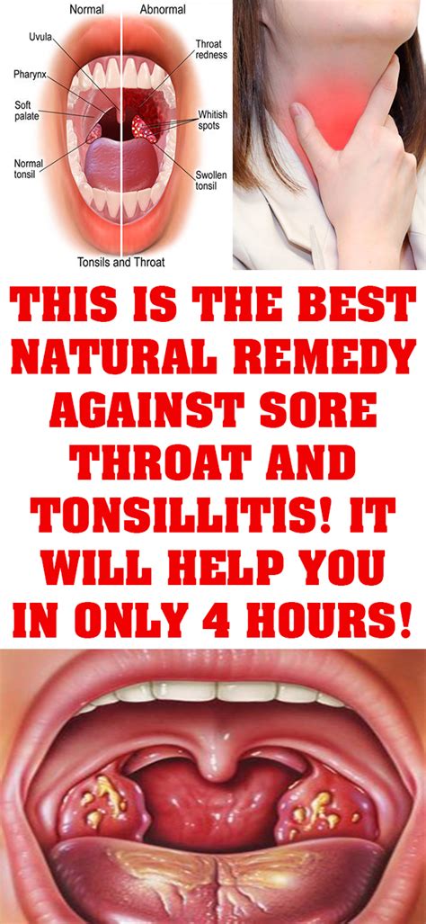 This Is The Best Natural Remedy Against Sore Throat And Tonsillitis It Will Help You In Only