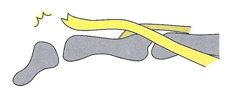 つき指（マレット変形・槌指） - 久美接骨院（名古屋市中村区）