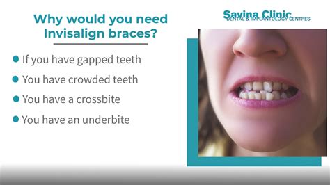 Invisalign Braces Frequently Asked Questions Savina Dental Clinics