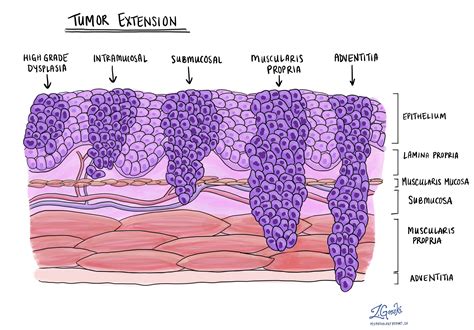 Squamous Cell Carcinoma Of The Esophagus Mypathologyreportca